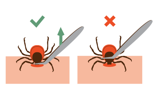 Illustration showing correct and incorrect tick removal techniques. On the left, a green checkmark shows tweezers pulling straight up and away from skin. On the right, a red X shows tweezers positioned at an angle, demonstrating what to avoid.